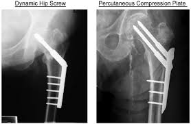 intertrochanteric hip fractures