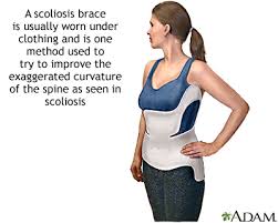 scoliosis symptoms and causes penn