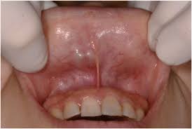 myoepithelioma in the upper lip
