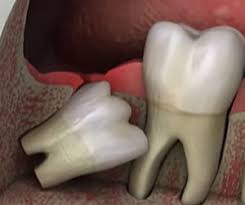 wisdom teeth removal caln family dental