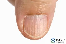 vertical lines on fingernails may