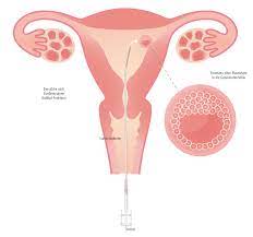 Ei, ovum) gespritzt, so dass ein. Kinderwunsch Behandlung Embryo Transfer