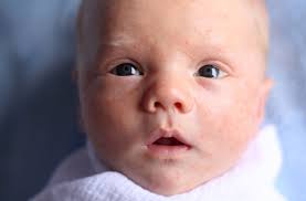 milk spots in newborns causes