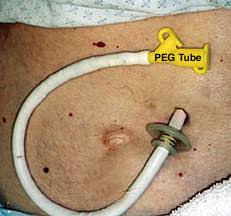 Image result for Percutaneous endoscopic gastrostomy