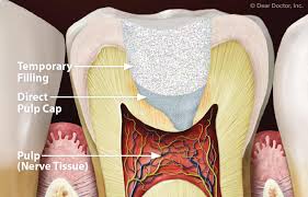 The deeper the original cavity, the higher the chance of developing postoperative sensitivity with any dental filling. Pulp Capping
