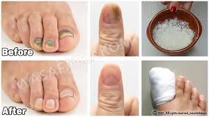 how to treat fungal nail infection
