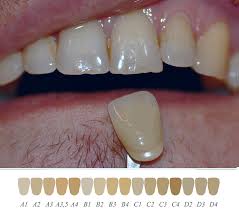 best tooth color match image ysis