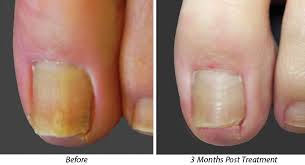 laser treatment for toenail fungus ca