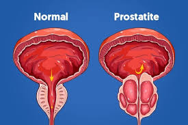 Antibiotico Para Prostatite Aguda - Melhor Tratamento Para Prostatite  Cronica
