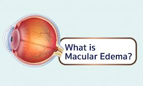 what is macular edema