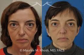 blepharoplasty for younger looking eyes