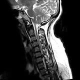 Image result for icd 10 code for lumbar disc extrusion