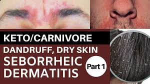 keto carnivore dandruff dry skin