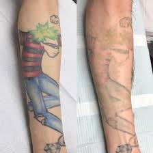 laser tattoo removal vancouver bc