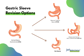 gastric sleeve revision an ultimate