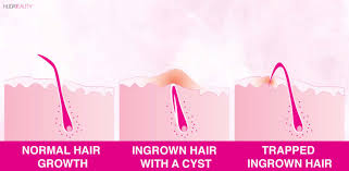how to get rid of ingrown hairs the
