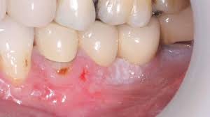 whiten teeth damage health