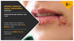 herpes simplex virus treatment market