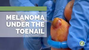 melanoma under the toenail you