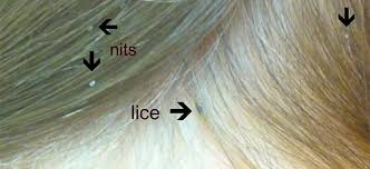 how to identify head lice lice
