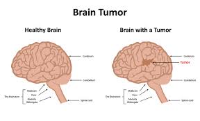 Rarely, brain tumors are the result of exposure to radiation or linked to a familial cancer syndrome. 8 Brain Tumor Signs That Need Immediate Attention Medanta