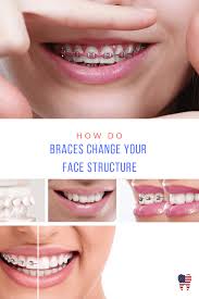 Last tip is again kind of tongue posture but not when you're resting but when you are chewing when you eat something drink. How Do Braces Change Your Face Structure Best Orthodontist Usa