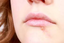 cold sores in kids causes symptoms