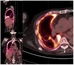 Check spelling or type a new query. Prognostic Value Of Pretreatment Volume Based Quantitative 18f Fdg Pet Ct Parameters In Patients With Malignant Pleural Mesothelioma European Journal Of Radiology
