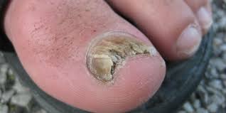 how to treat your fungal nail infection