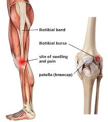 it band syndrome knee pain symptoms