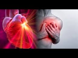 También llamado ataque agudo al corazón , sucede cuando la sangre que llega al músculo cardíaco es reducida o totalmente cortada por el bloqueo en una o más arterias coronarias. Que Es Un Infarto Agudo Al Miocardio Youtube