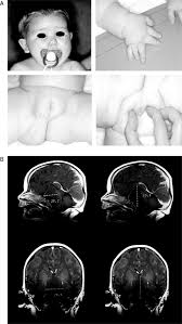 nail dysplasia an overview