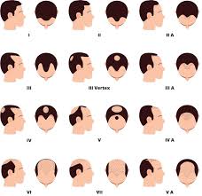 Male Pattern Baldness Surgical And Natural Treatments