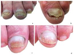 dermatophytes causing onychomycosis