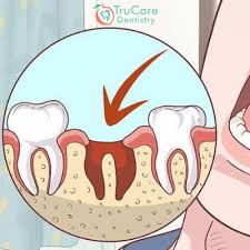 dry sockets post tooth extraction