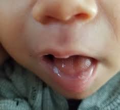 baby white spots in mouth babycenter