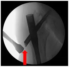 management of lateral thigh pain