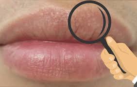 what are fordyce spots on lips causes