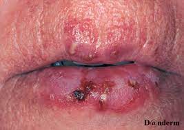 6 14 discoid lupus erythematosus on the