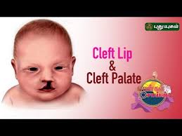 facts about cleft lip and cleft palate