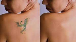 laser tattoo removal in delhi