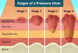 pressure ulcer bedsore treatment for