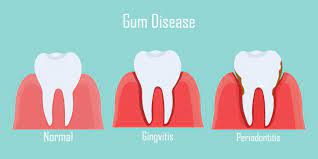 the causes of gum disease mark r