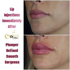 types of lip filler injections at