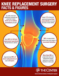 knee replacement surgery by the numbers
