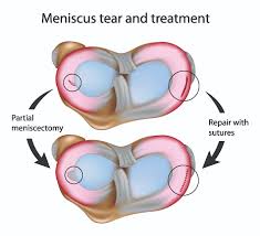meniscus repair treatment in mrc nagar