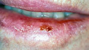 p on lip causes treatment and
