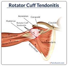 Image result for tendonitis