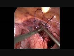 pelvic organ prolapse surgery