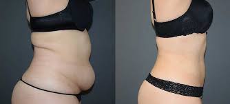 laser liposuction treatment south